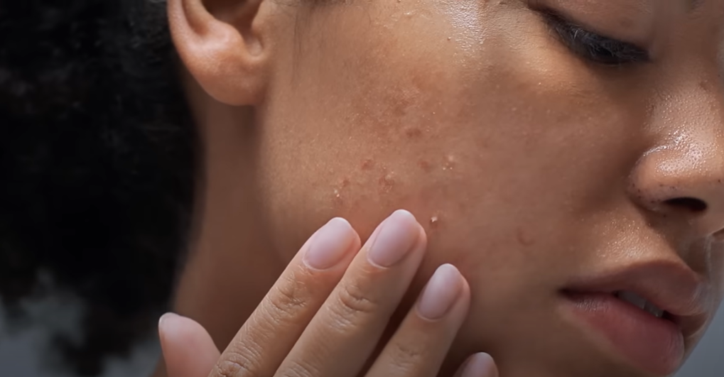 Best CeraVe Products for Acne