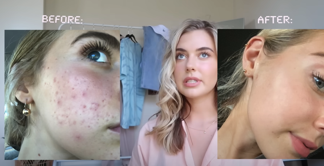 best toner for acne prone skin